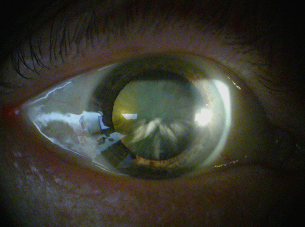 2016 Cataract Surgery Audit