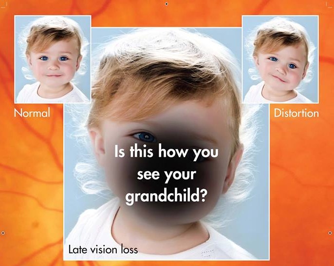 How Age-Related Macular Degeneration Can Slowly Affect Vision