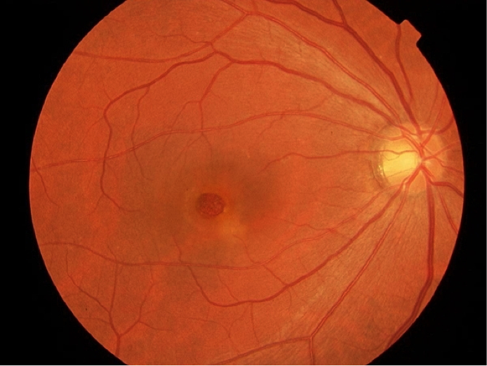 3 Common Retinal Conditions and What they May Mean for Your Vision